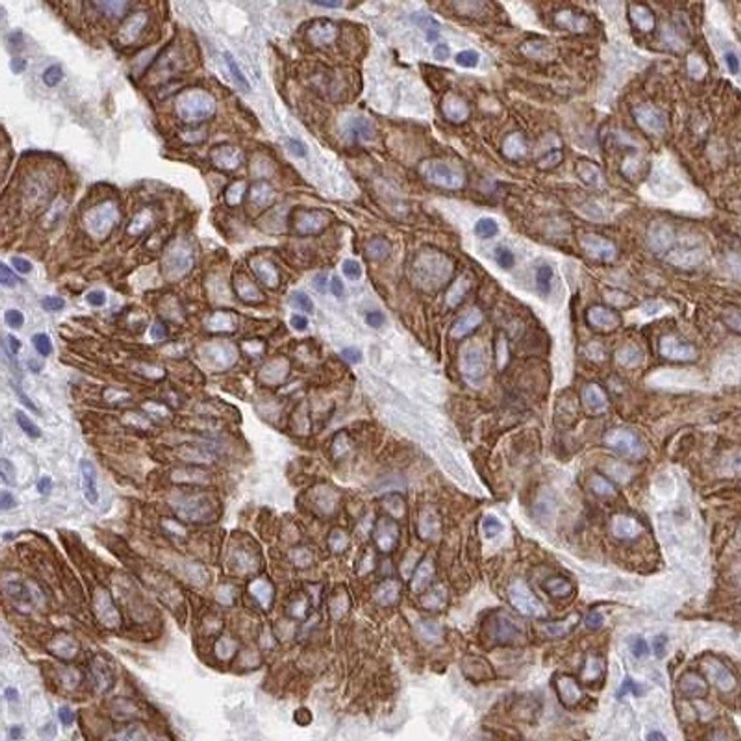 Immunohistochemistry: ZIK1 Antibody [NBP2-32507] - pancreatic cancer