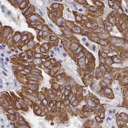 Immunohistochemistry: ZIK1 Antibody [NBP2-32507] - pancreatic cancer