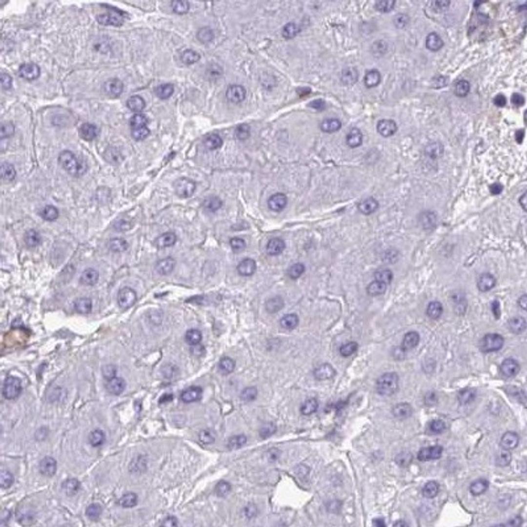 Immunohistochemistry: SIGLEC11 Antibody [NBP2-32523] - liver cancer