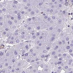 Immunohistochemistry: SIGLEC11 Antibody [NBP2-32523] - liver cancer