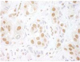 Immunohistochemistry-Paraffin: PRPF3 Antibody [NBP1-19114] - FFPE section of human breast carcinoma.  Affinity purified rabbit anti-hPrp3p used at a dilution of 1:100.