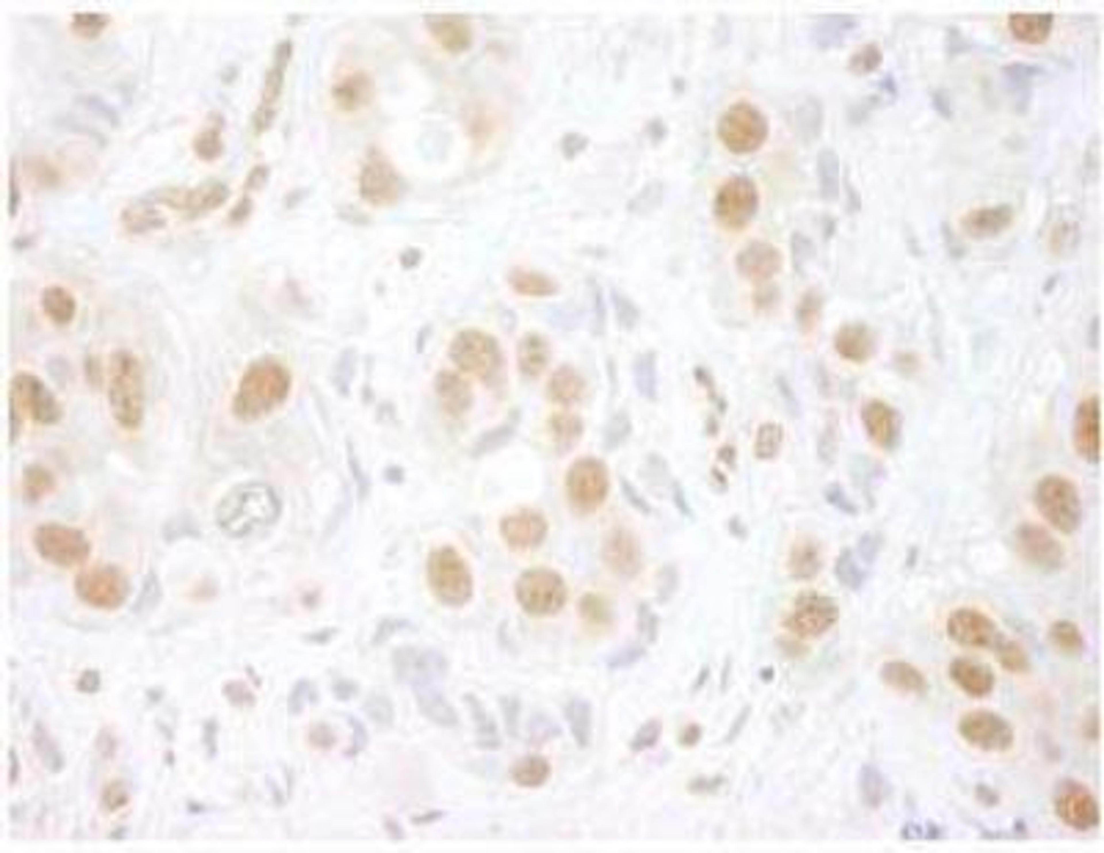 Immunohistochemistry-Paraffin: PRPF3 Antibody [NBP1-19114] - FFPE section of human breast carcinoma.  Affinity purified rabbit anti-hPrp3p used at a dilution of 1:100.