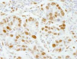 Immunohistochemistry-Paraffin: DNA Polymerase epsilon Antibody [NB100-60438] - FFPE section of human breast carcinoma.   Affinity purified rabbit anti-PolE3/p17 1:100.  Detection: DAB staining using Immunohistochemistry Accessory Kit