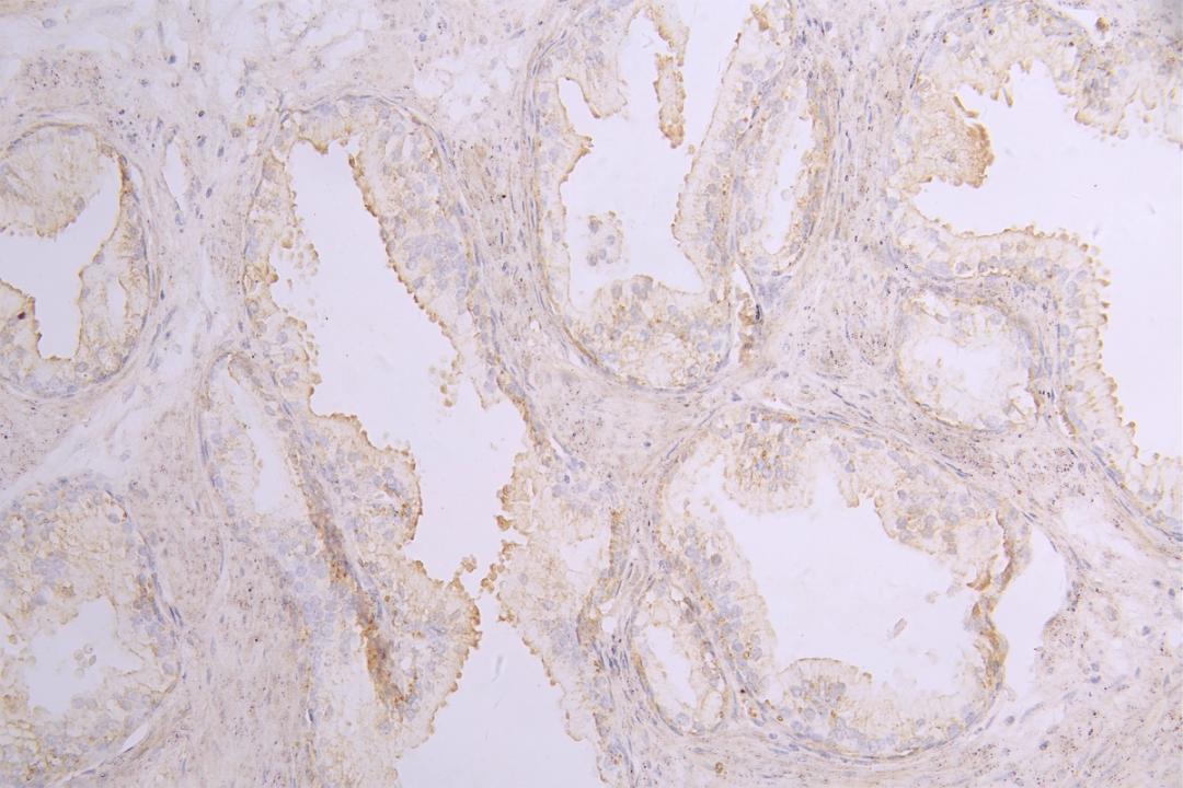 IHC image of CSB-RA859530MA1HU diluted at 1：100 and staining in paraffin-embedded human prostate cancer performed on a Leica BondTM system. After dewaxing and hydration, antigen retrieval was mediated by high pressure in a citrate buffer (pH 6.0). Section was blocked with 10% normal goat serum 30min at RT. Then primary antibody (1% BSA) was incubated at 4°C overnight. The primary is detected by a Goat anti-human polymer IgG labeled by HRP and visualized using 0.05% DAB.