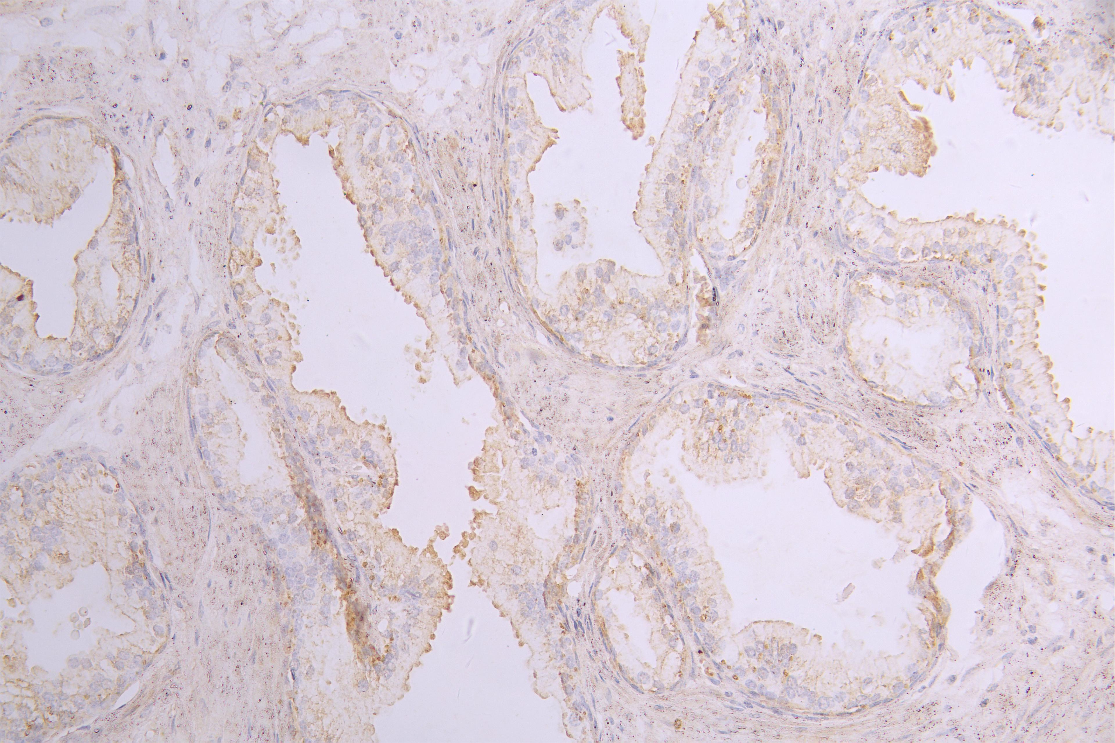 IHC image of CSB-RA859530MA1HU diluted at 1：100 and staining in paraffin-embedded human prostate cancer performed on a Leica BondTM system. After dewaxing and hydration, antigen retrieval was mediated by high pressure in a citrate buffer (pH 6.0). Section was blocked with 10% normal goat serum 30min at RT. Then primary antibody (1% BSA) was incubated at 4°C overnight. The primary is detected by a Goat anti-human polymer IgG labeled by HRP and visualized using 0.05% DAB.