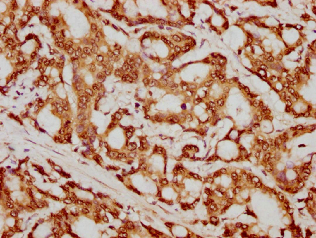 IHC image of CSB-PA010429PA79nforHU diluted at 1:20 and staining in paraffin-embedded human colon cancer performed on a Leica BondTM system. After dewaxing and hydration, antigen retrieval was mediated by high pressure in a citrate buffer (pH 6.0). Section was blocked with 10% normal goat serum 30min at RT. Then primary antibody (1% BSA) was incubated at 4°C overnight. The primary is detected by a biotinylated secondary antibody and visualized using an HRP conjugated SP system.