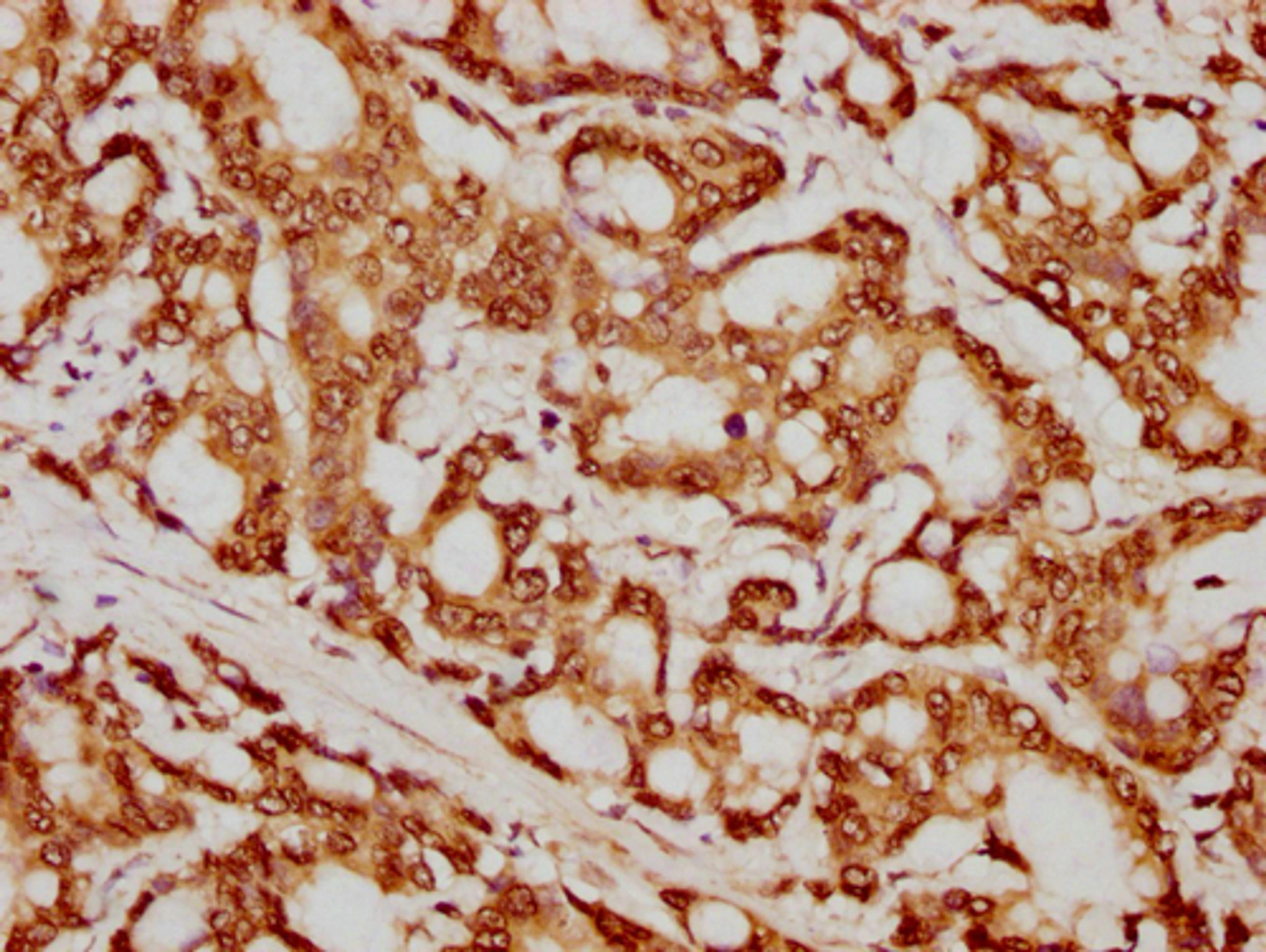 IHC image of CSB-PA010429PA79nforHU diluted at 1:20 and staining in paraffin-embedded human colon cancer performed on a Leica BondTM system. After dewaxing and hydration, antigen retrieval was mediated by high pressure in a citrate buffer (pH 6.0). Section was blocked with 10% normal goat serum 30min at RT. Then primary antibody (1% BSA) was incubated at 4°C overnight. The primary is detected by a biotinylated secondary antibody and visualized using an HRP conjugated SP system.