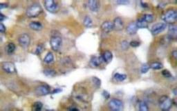 Immunohistochemistry: Cytokeratin 19/10/12 Antibody [NB100-91846] -  Immunohistochemistry  (IHC)  analyzes of  Keratin19/10/12 (M259) antibody in paraffin-embedded  human breast carcinoma tissue