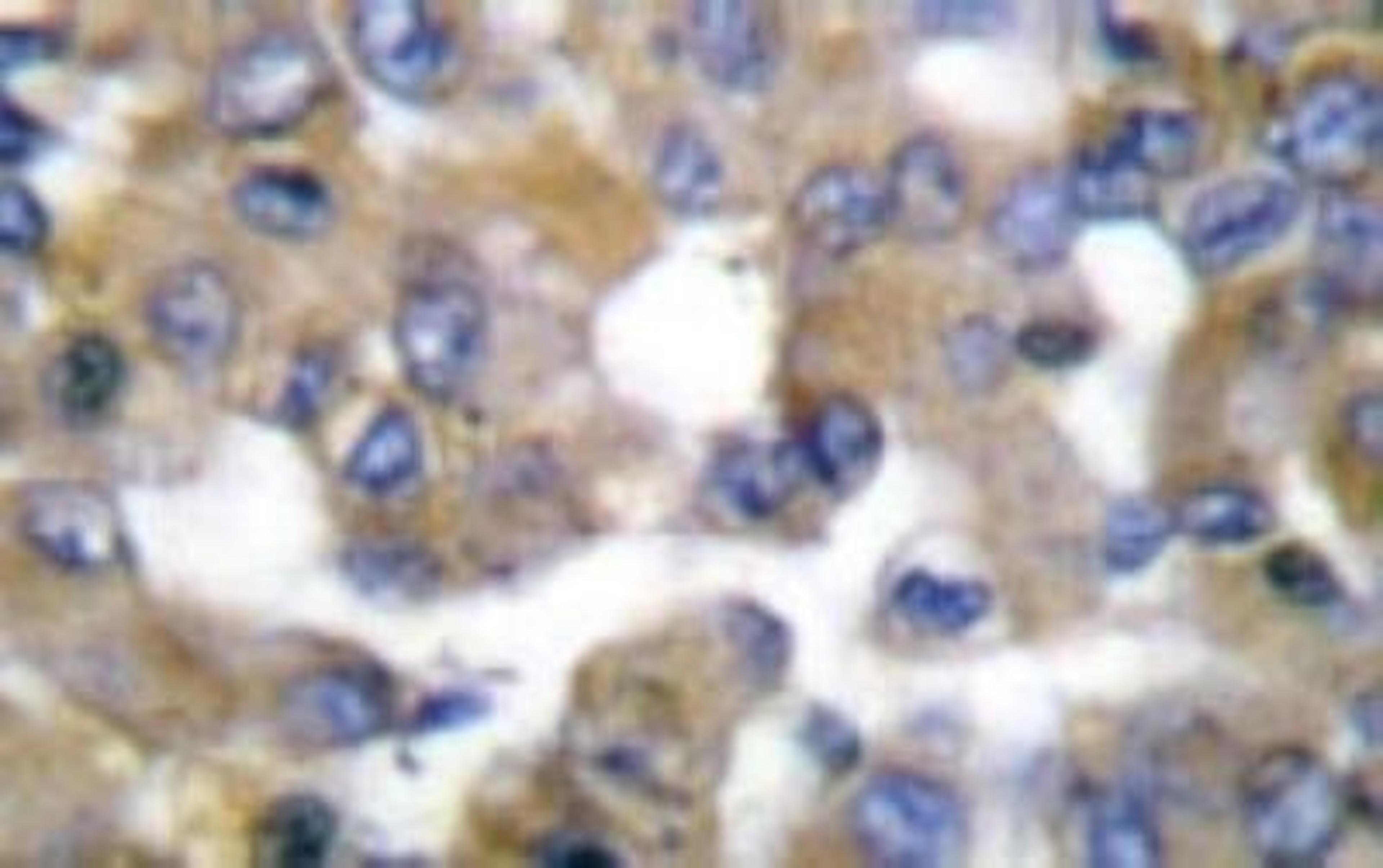 Immunohistochemistry: Cytokeratin 19/10/12 Antibody [NB100-91846] -  Immunohistochemistry  (IHC)  analyzes of  Keratin19/10/12 (M259) antibody in paraffin-embedded  human breast carcinoma tissue