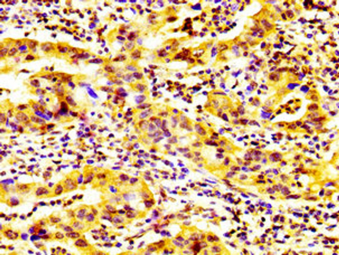 IHC image of CSB-PA872550LA01HU diluted at 1:600 and staining in paraffin-embedded human bladder cancer performed on a Leica BondTM system. After dewaxing and hydration, antigen retrieval was mediated by high pressure in a citrate buffer (pH 6.0). Section was blocked with 10% normal goat serum 30min at RT. Then primary antibody (1% BSA) was incubated at 4&deg;C overnight. The primary is detected by a biotinylated secondary antibody and visualized using an HRP conjugated SP system.