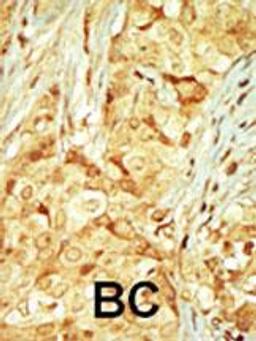 Formalin-fixed and paraffin-embedded human cancer tissue reacted with the primary antibody, which was peroxidase-conjugated to the secondary antibody, followed by DAB staining. BC = breast carcinoma; HC = hepatocarcinoma.