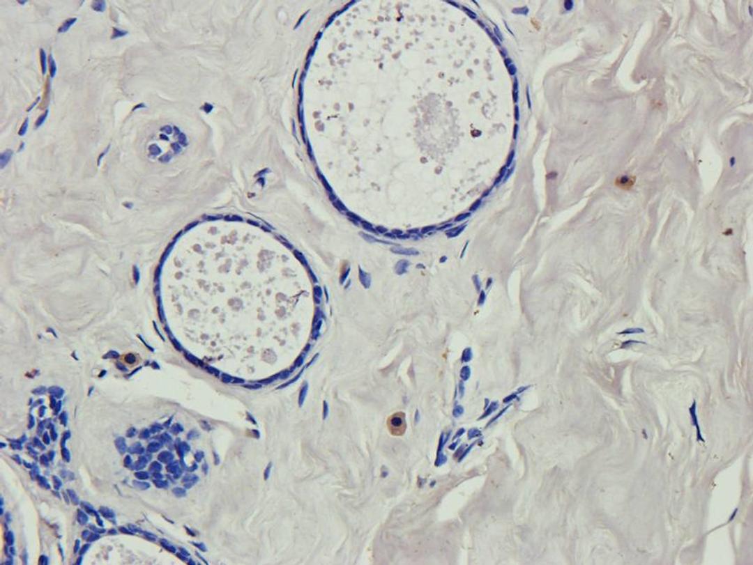 Immunohistochemical staining of human thyroid cancer tissue using RNF4 antibody (2.5 ug/ml)