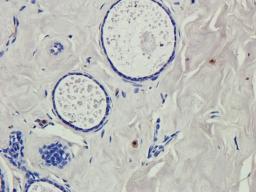 Immunohistochemical staining of human thyroid cancer tissue using RNF4 antibody (2.5 ug/ml)