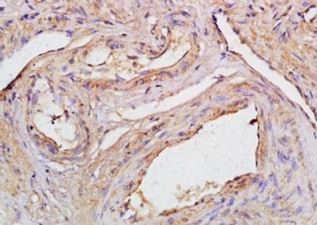 Immunohistochemical analysis of formalin-fixed paraffin embedded human cervical carcinoma tissue using CCDC90A antibody (dilution at 1:200)