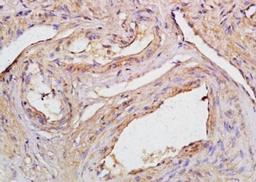 Immunohistochemical analysis of formalin-fixed paraffin embedded human cervical carcinoma tissue using CCDC90A antibody (dilution at 1:200)