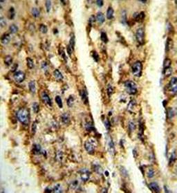 Immunohistrochemical analysis of formalin-fixed and paraffin-embedded human hepatocarcinoma tissue using DIO3 antibody