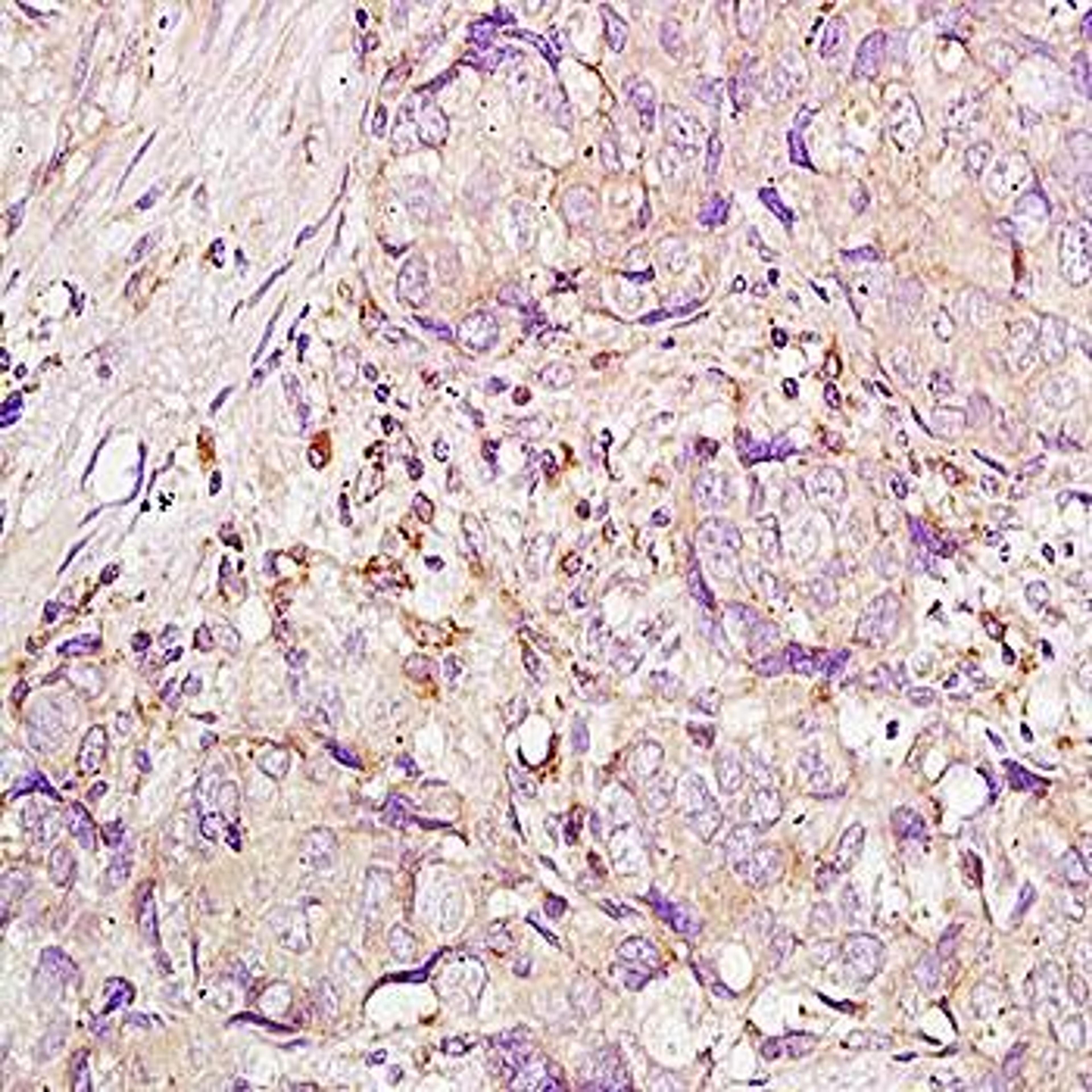 Immunohistochemical analysis of formalin-fixed and paraffin embedded human laryngeal carcinoma tissue (Dilution at:1:200) using Integrin alpha 4+Beta 7 antibody