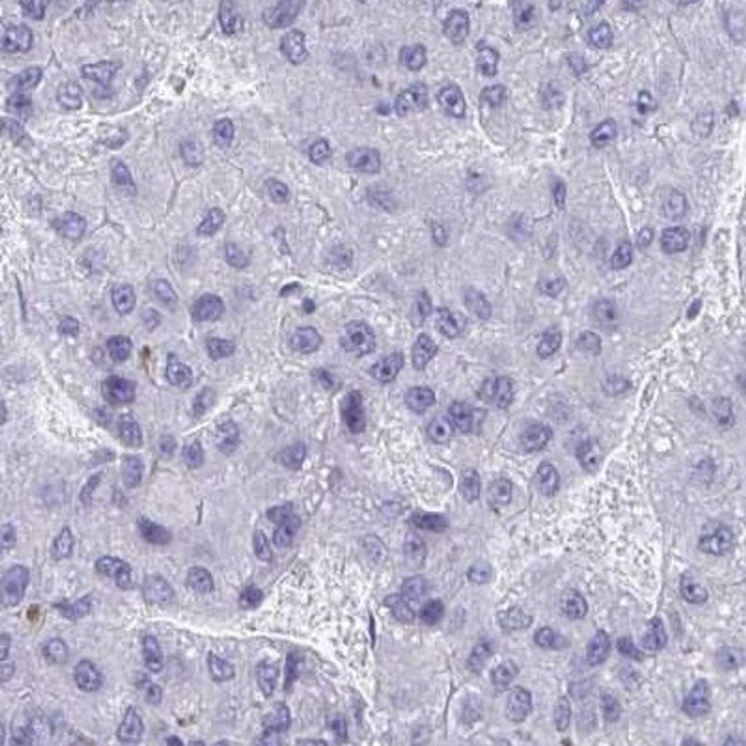 Immunohistochemistry: ZNF545 Antibody [NBP2-31823] - liver cancer