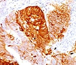 IHC testing of FFPE human colon carcinoma with ALDH1 antibody (clone AHDH1-1).