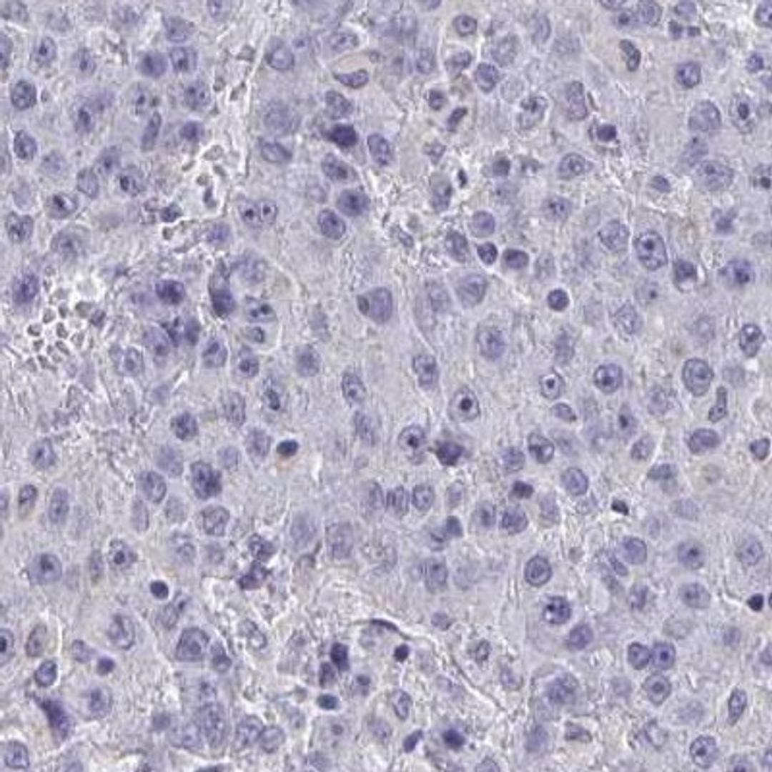 Immunohistochemistry: TMEM82 Antibody [NBP2-31814] - liver cancer