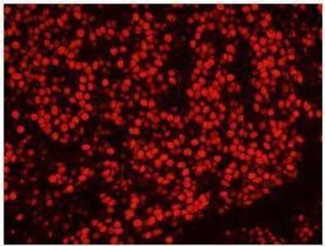 Immunocytochemistry/Immunofluorescence: SFPQ Antibody [NB100-61045] - FFPE section of human breast carcinoma.   Antibody used at a dilution of 1:100. Detection: Red-fluorescent goat anti-rabbit IgG highly cross-adsorbed Antibody Hilyte PlusTM 555 used at a dilution of 1:100.