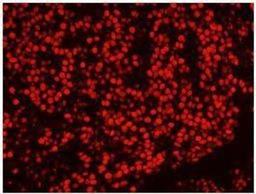 Immunocytochemistry/Immunofluorescence: SFPQ Antibody [NB100-61045] - FFPE section of human breast carcinoma.   Antibody used at a dilution of 1:100. Detection: Red-fluorescent goat anti-rabbit IgG highly cross-adsorbed Antibody Hilyte PlusTM 555 used at a dilution of 1:100.