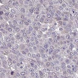 Immunohistochemistry: MGC2803 Antibody [NBP2-31806] - liver cancer