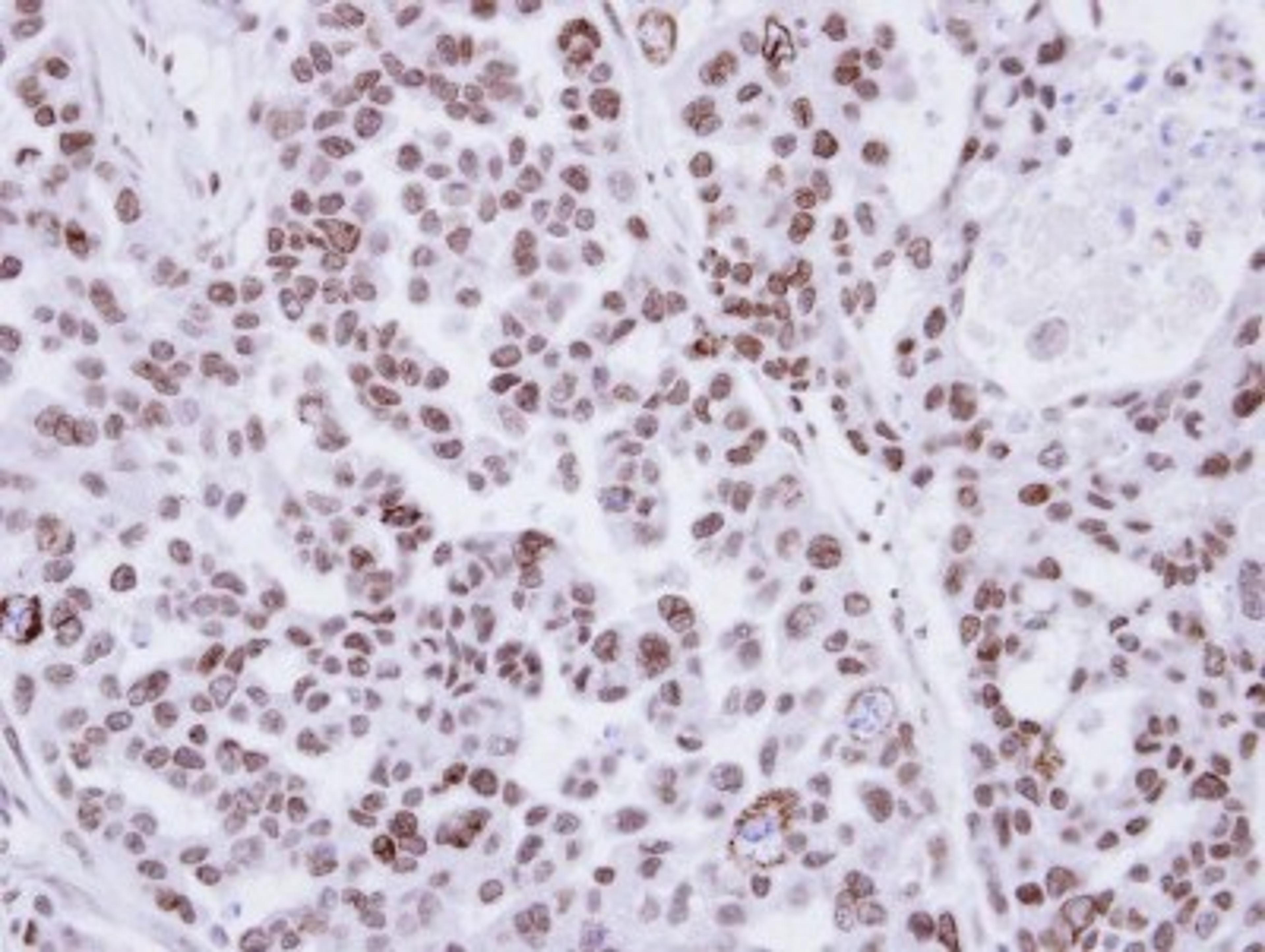 Immunohistochemistry-Paraffin: PAG608 Antibody [NBP1-32543] - Paraffin-embedded OVCAR3 xenograft, using antibody at 1:100 dilution.