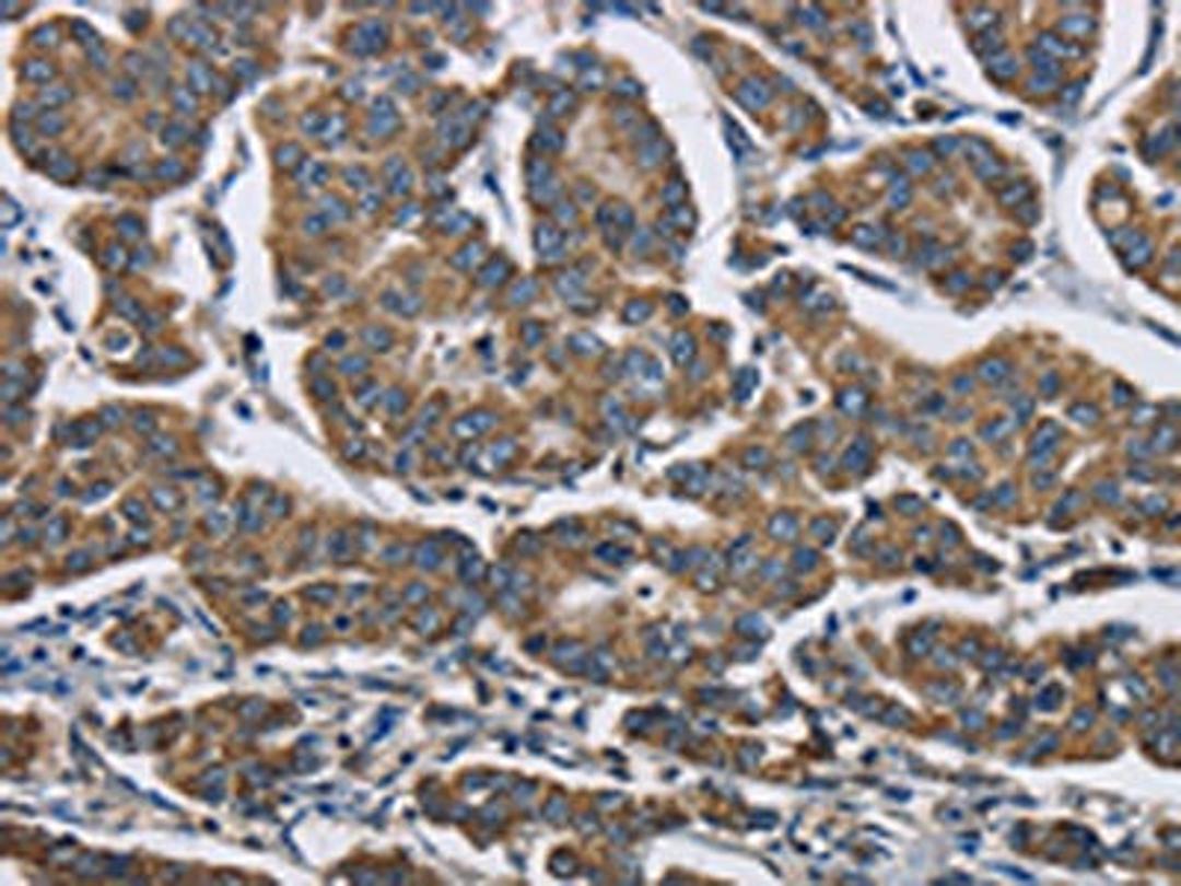 The image is immunohistochemistry of paraffin-embedded Human breast cancer tissue using CSB-PA874417(AGER Antibody) at dilution 1/70. (Original magnification: ×200)