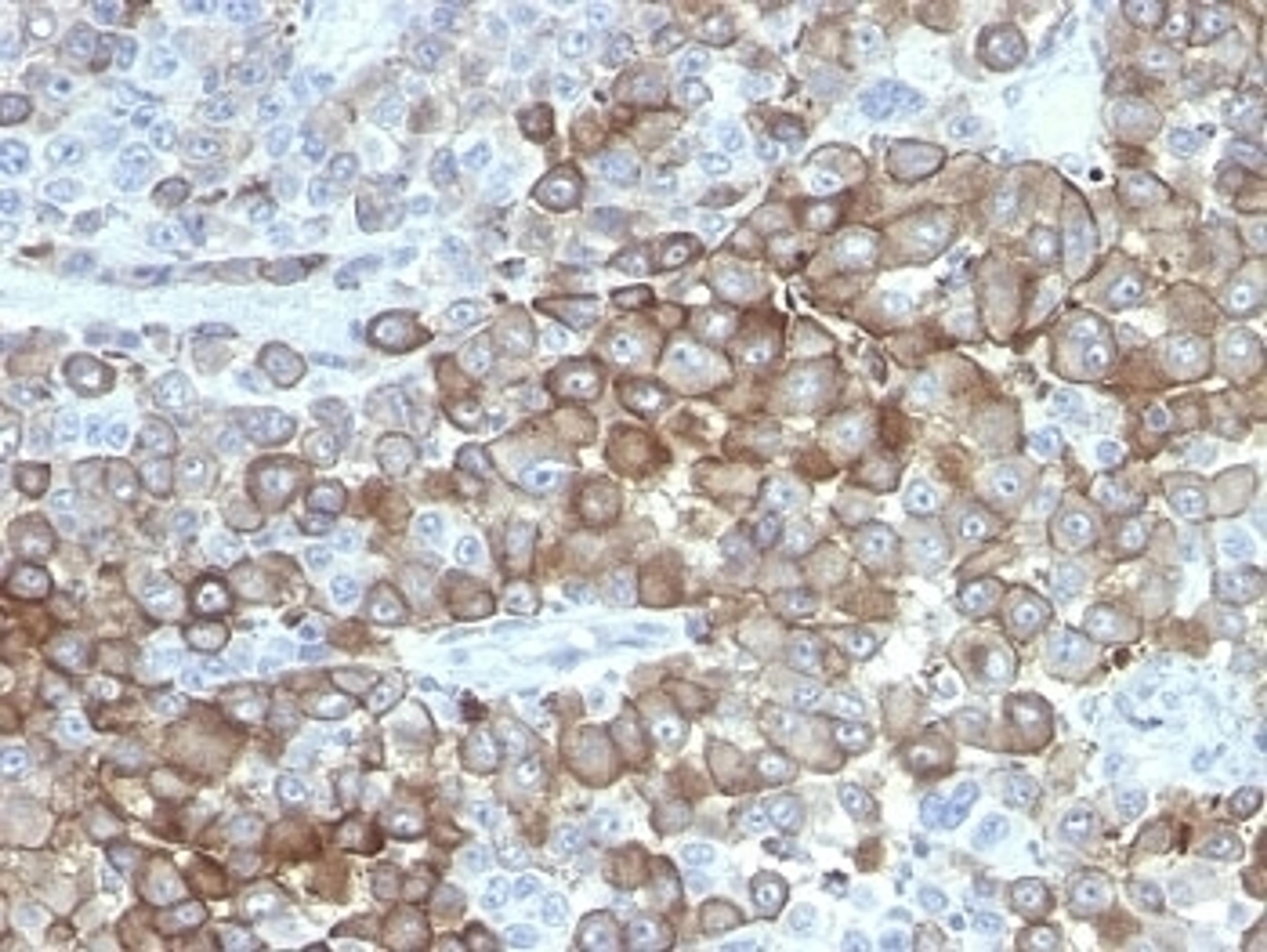 Formalin-fixed, paraffin-embedded human melanoma stained with Melanoma antibody.