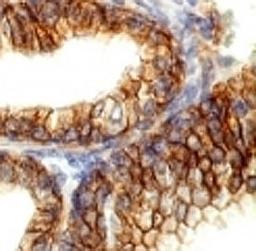 IHC testing of FFPE human colon carcinoma and E-Cadherin antibody (ECD1-1).