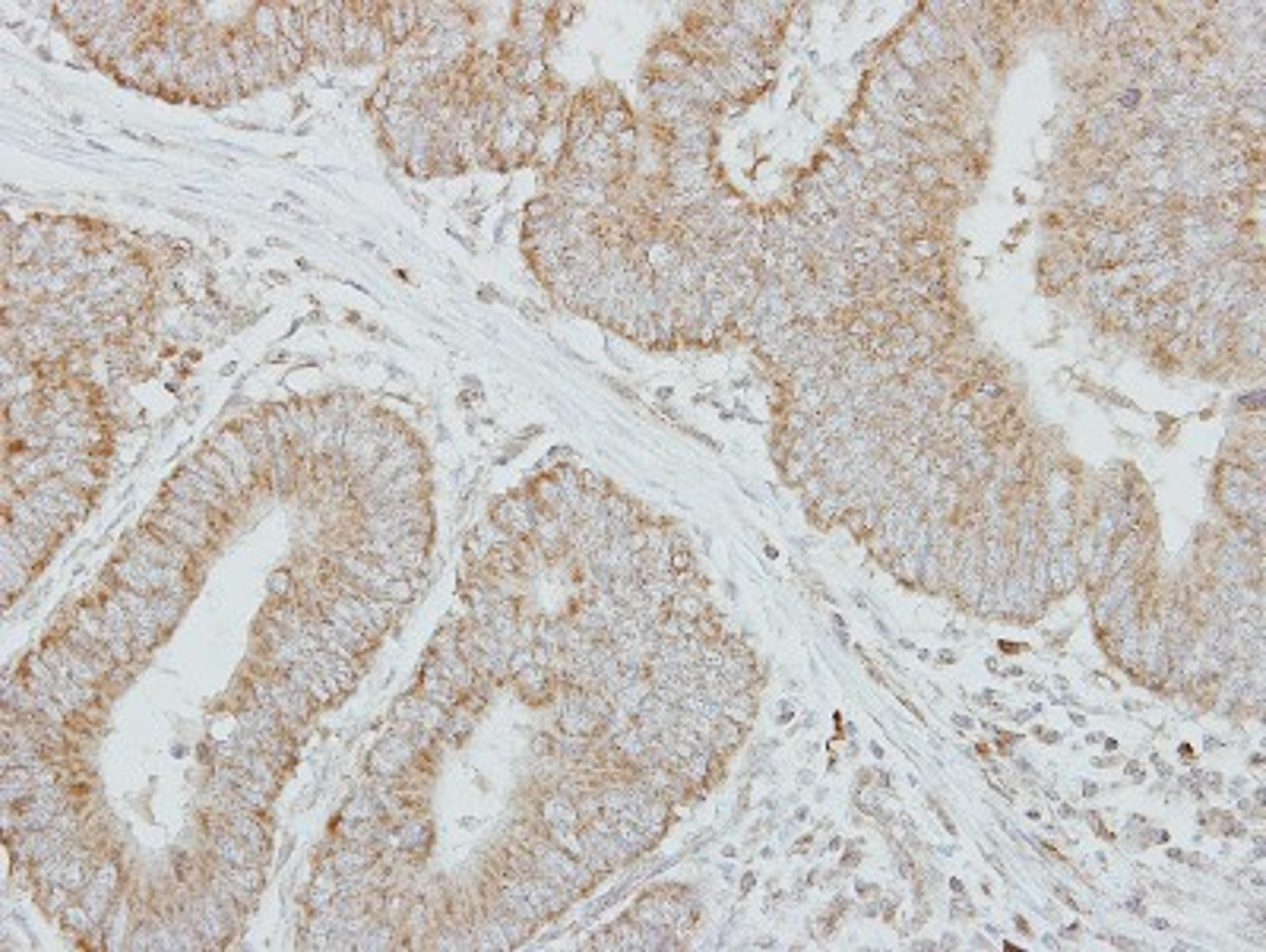 Immunohistochemistry-Paraffin: Factor IX Antibody [NBP1-33581] - Paraffin-embedded Colon ca, using antibody at 1:250 dilution.