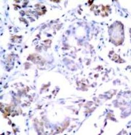 Immunohistochemical analysis of paraffin-embedded human breast carcinoma tissue using NF&#954;B-p65 (Ab-254).