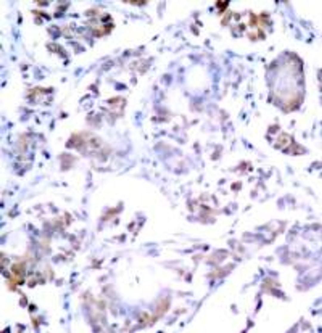 Immunohistochemical analysis of paraffin-embedded human breast carcinoma tissue using NFκB-p65 (Ab-254).