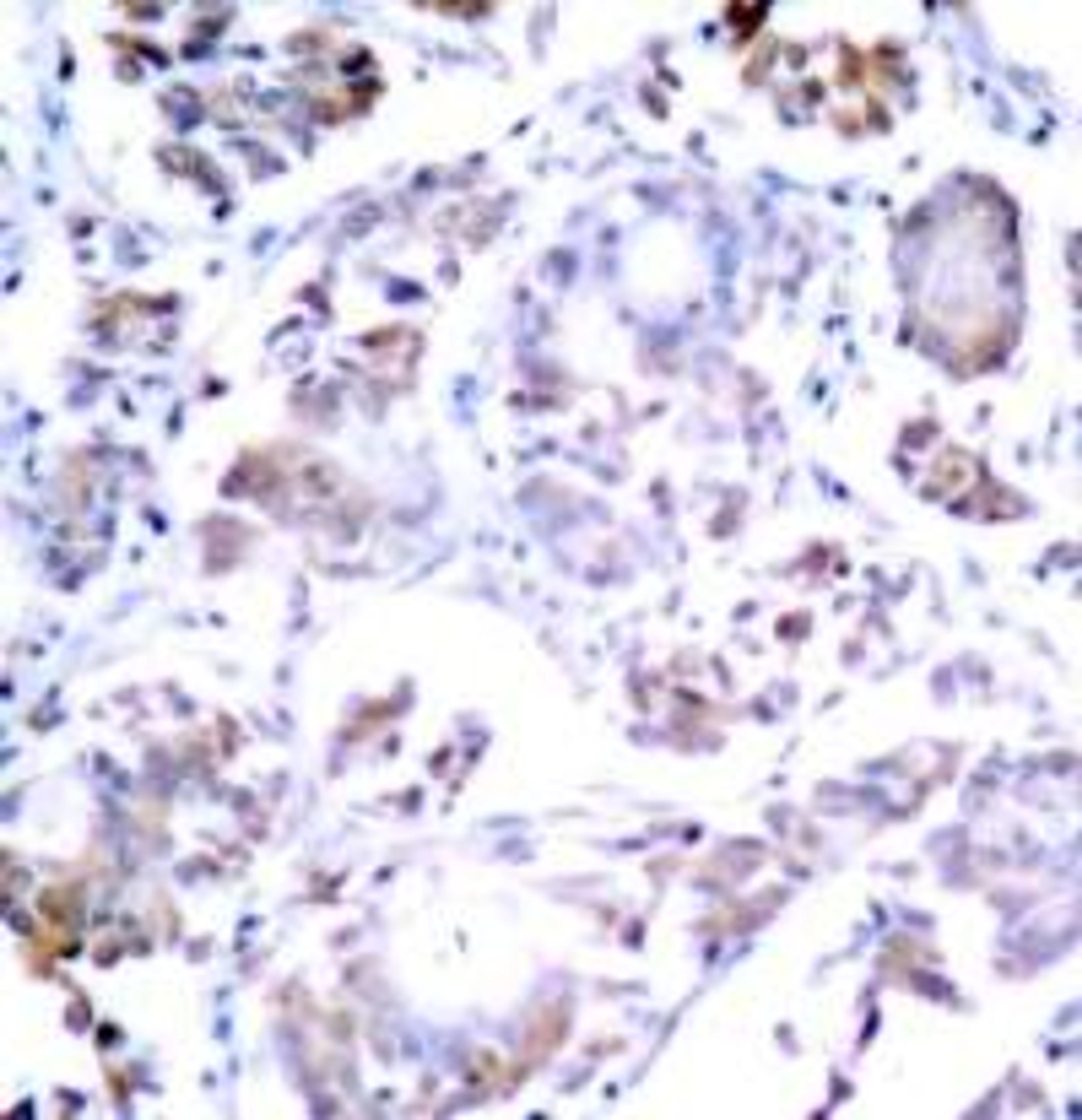 Immunohistochemical analysis of paraffin-embedded human breast carcinoma tissue using NFκB-p65 (Ab-254).