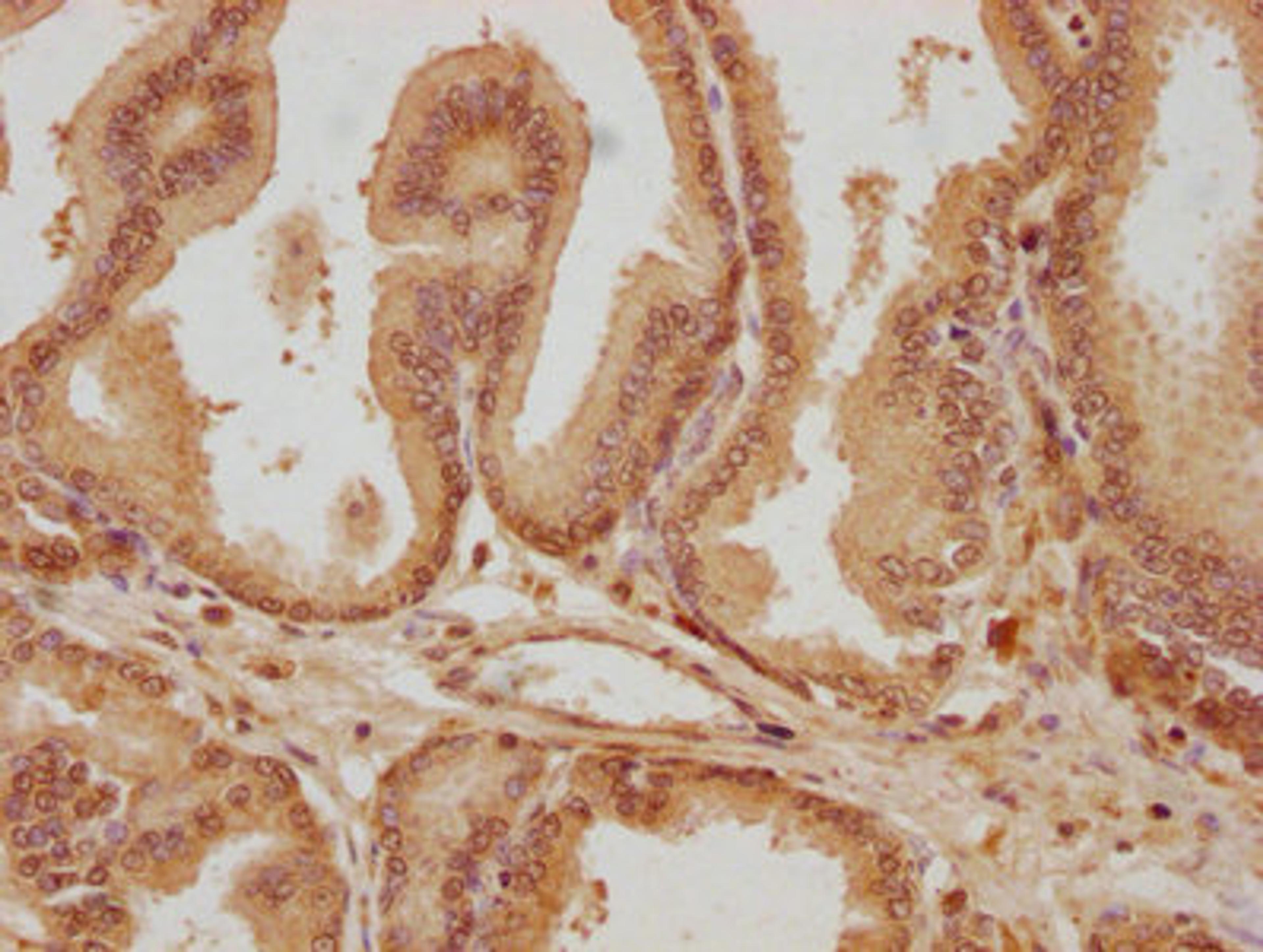IHC image of CSB-PA814232LA01HU diluted at 1:300 and staining in paraffin-embedded human prostate tissue performed on a Leica BondTM system. After dewaxing and hydration, antigen retrieval was mediated by high pressure in a citrate buffer (pH 6.0). Section was blocked with 10% normal goat serum 30min at RT. Then primary antibody (1% BSA) was incubated at 4°C overnight. The primary is detected by a biotinylated secondary antibody and visualized using an HRP conjugated SP system.