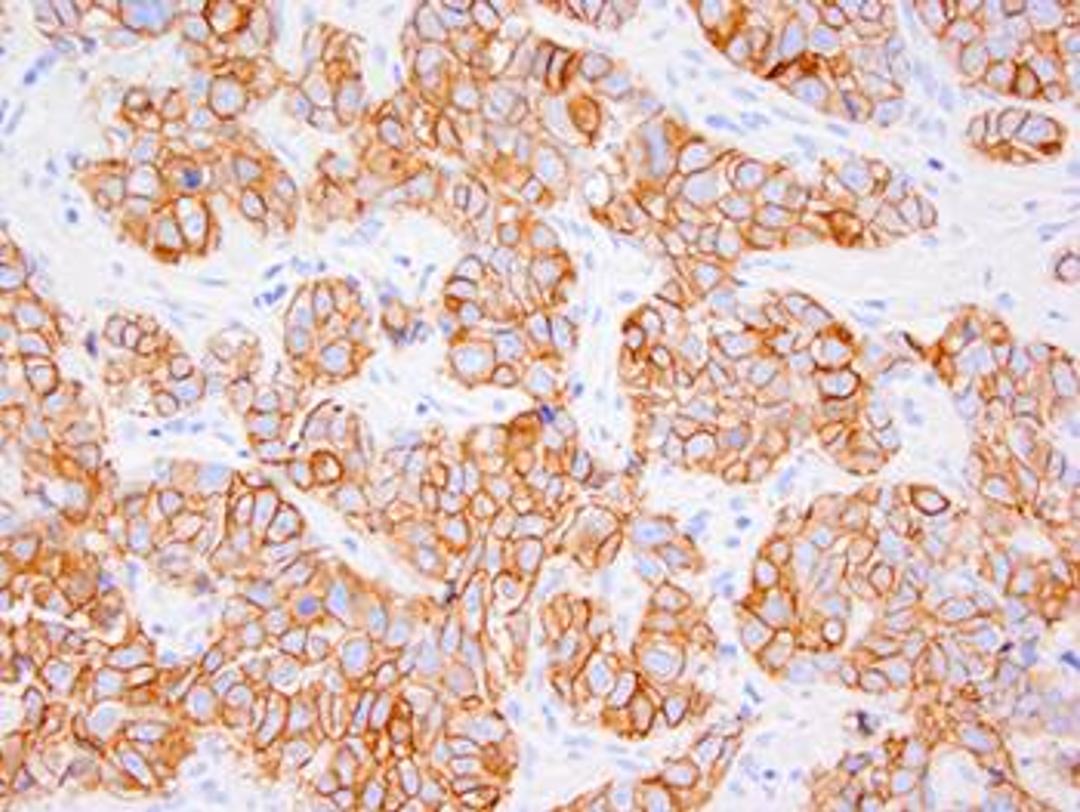 Immunohistochemical staining of using C-erbB-2 Onkoprotein antibody