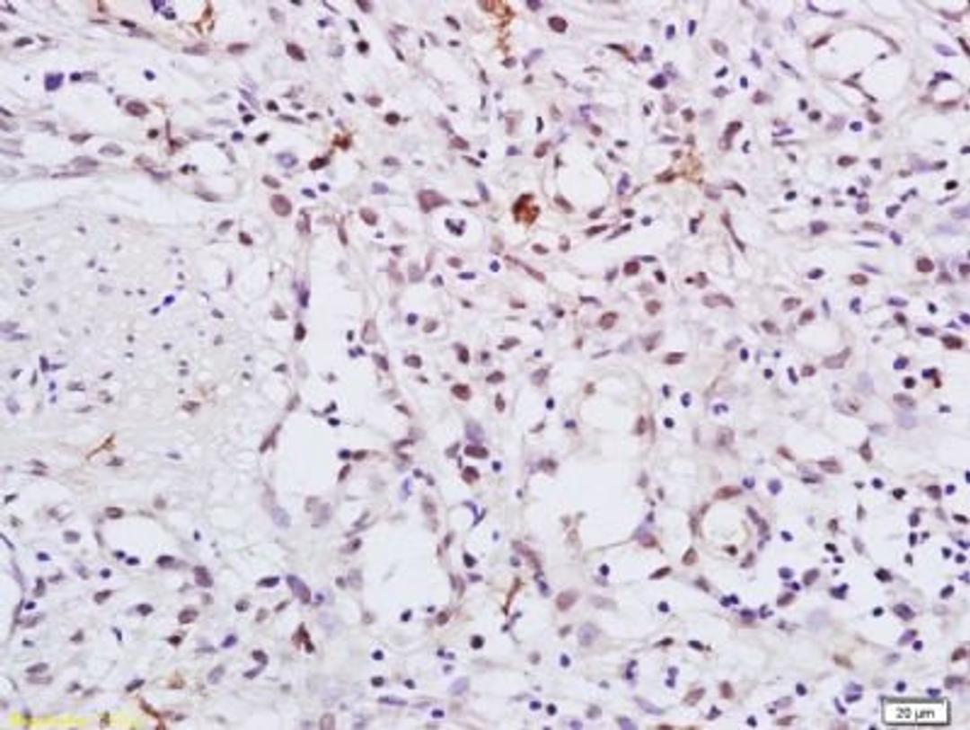 Immunohistochemical staining of human gastric carcinoma tissue using HSP90 alpha (phospho-Thr5-7) antibody.