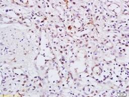 Immunohistochemical staining of human gastric carcinoma tissue using HSP90 alpha (phospho-Thr5-7) antibody.