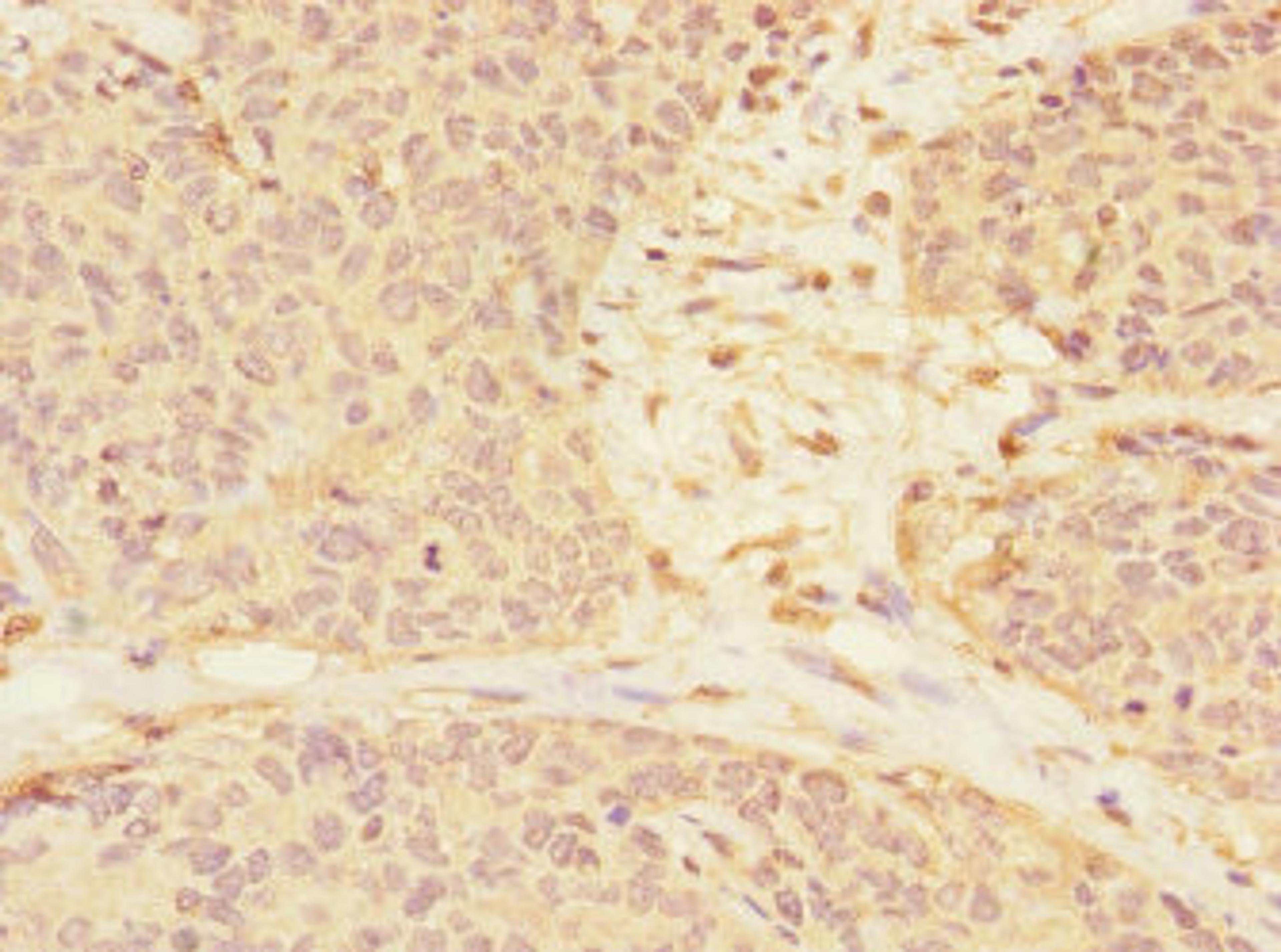 Immunohistochemistry of paraffin-embedded human ovarian cancer using CSB-PA754570ESR2HU at dilution of 1:100