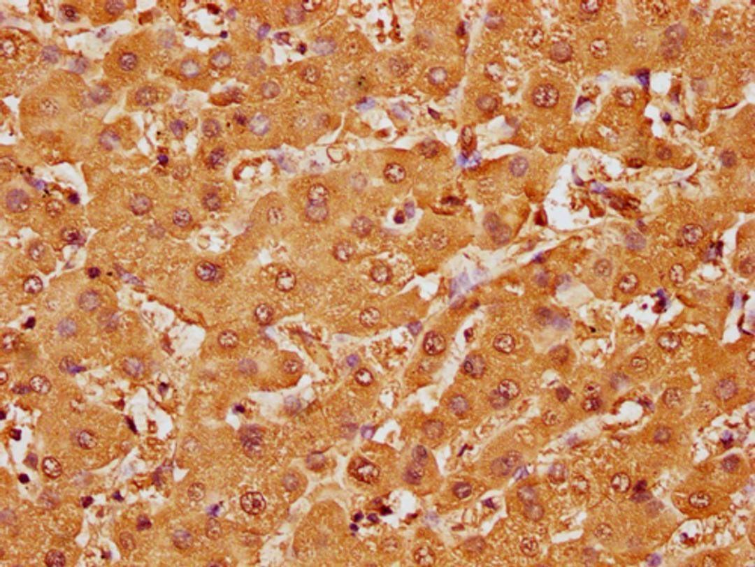 IHC image of CSB-PA010087OA107nme1HU diluted at 1:10 and staining in paraffin-embedded human liver tissue performed on a Leica BondTM system. After dewaxing and hydration, antigen retrieval was mediated by high pressure in a citrate buffer (pH 6.0). Section was blocked with 10% normal goat serum 30min at RT. Then primary antibody (1% BSA) was incubated at 4°C overnight. The primary is detected by a biotinylated secondary antibody and visualized using an HRP conjugated SP system.