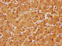 IHC image of CSB-PA010087OA107nme1HU diluted at 1:10 and staining in paraffin-embedded human liver tissue performed on a Leica BondTM system. After dewaxing and hydration, antigen retrieval was mediated by high pressure in a citrate buffer (pH 6.0). Section was blocked with 10% normal goat serum 30min at RT. Then primary antibody (1% BSA) was incubated at 4°C overnight. The primary is detected by a biotinylated secondary antibody and visualized using an HRP conjugated SP system.