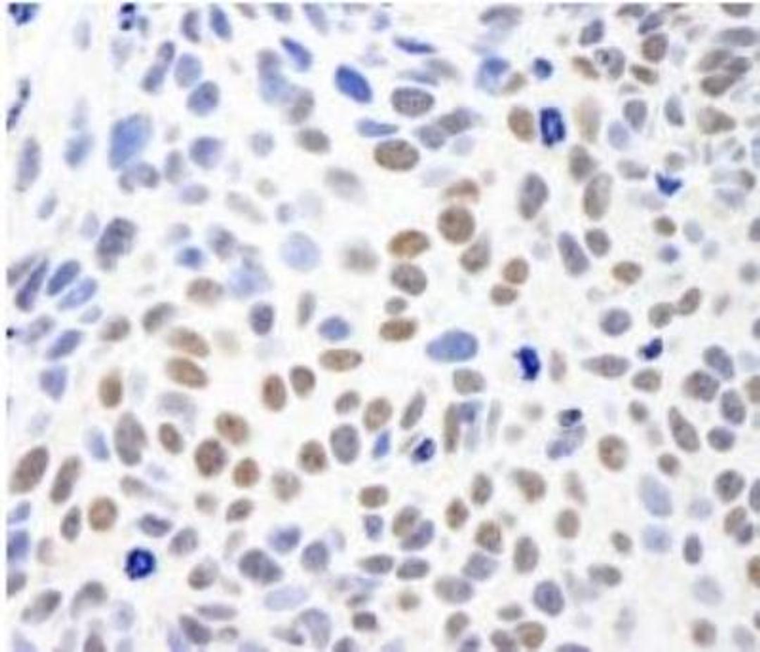 Immunohistochemistry-Paraffin: SMC1 Antibody [NB100-204] - Sample: FFPE section of human breast carcinoma.