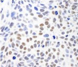 Immunohistochemistry-Paraffin: SMC1 Antibody [NB100-204] - Sample: FFPE section of human breast carcinoma.