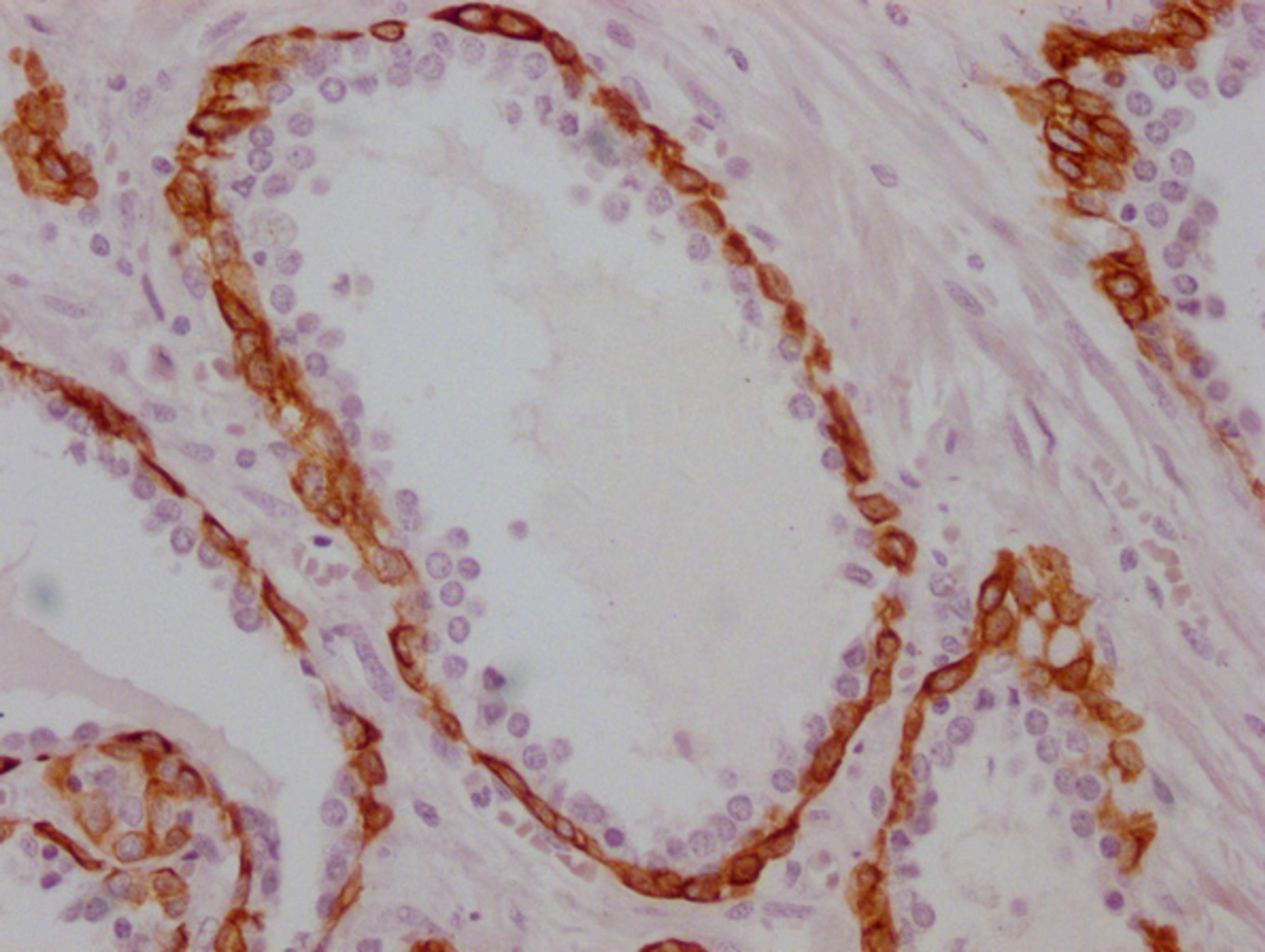 IHC image of CSB-MA986157 diluted at 1:100 and staining in paraffin-embedded human prostate cancer performed on a Leica BondTM system. After dewaxing and hydration, antigen retrieval was mediated by high pressure in a citrate buffer (pH 6.0). Section was blocked with 10% normal goat serum 30min at RT. Then primary antibody (1% BSA) was incubated at 4°C overnight. The primary is detected by a Goat anti-mouse IgG polymer labeled by HRP and visualized using 0.05% DAB.