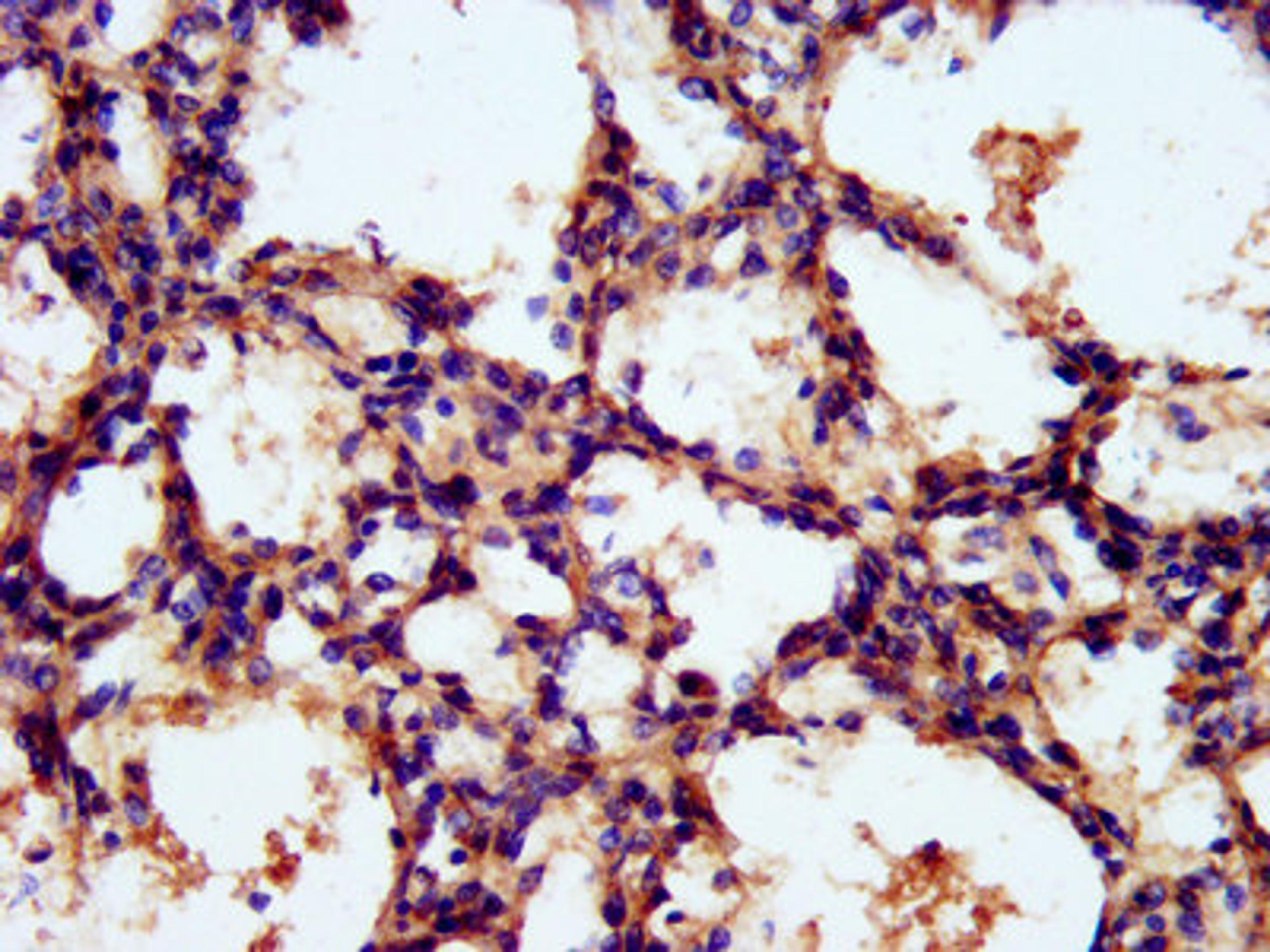 IHC image of CSB-PA871634LA01HU diluted at 1:300 and staining in paraffin-embedded human lung tissue performed on a Leica BondTM system. After dewaxing and hydration, antigen retrieval was mediated by high pressure in a citrate buffer (pH 6.0). Section was blocked with 10% normal goat serum 30min at RT. Then primary antibody (1% BSA) was incubated at 4°C overnight. The primary is detected by a biotinylated secondary antibody and visualized using an HRP conjugated SP system.