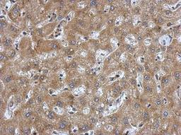 Immunohistochemistry-Paraffin: Atrial Natriuretic Peptide/ANP Antibody [NBP2-14873] - Paraffin-embedded Hepatoma, using antibody at 1:500 dilution.