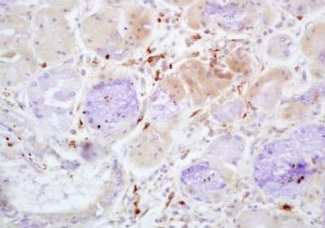 Immunohistochemical analysis of formalin-fixed paraffin embedded human lung carcinoma tissue using Properdin antibody (dilution at 1:200)