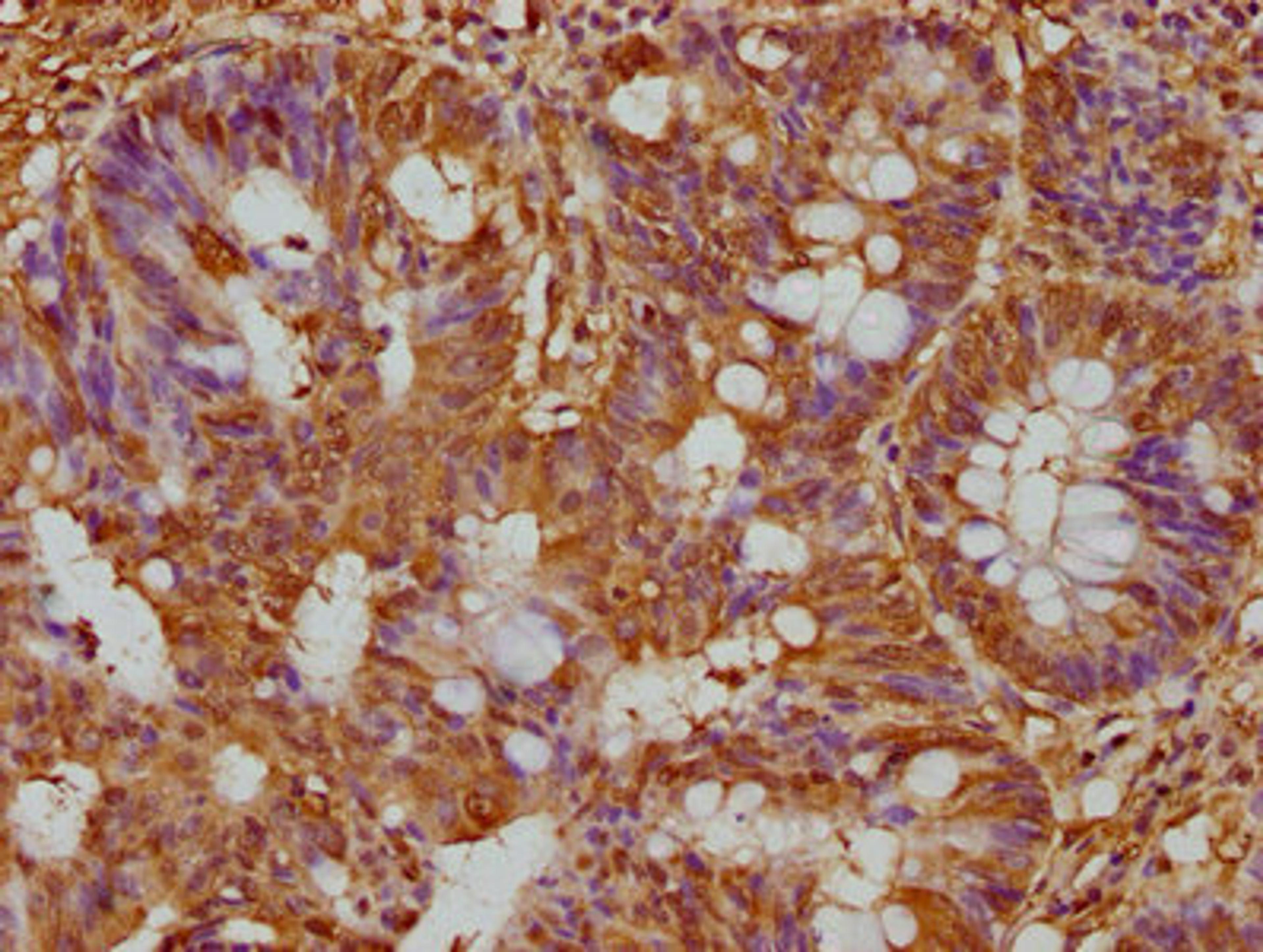 IHC image of CSB-PA847623LA01HU diluted at 1:300 and staining in paraffin-embedded human colon cancer performed on a Leica BondTM system. After dewaxing and hydration, antigen retrieval was mediated by high pressure in a citrate buffer (pH 6.0). Section was blocked with 10% normal goat serum 30min at RT. Then primary antibody (1% BSA) was incubated at 4°C overnight. The primary is detected by a biotinylated secondary antibody and visualized using an HRP conjugated SP system.