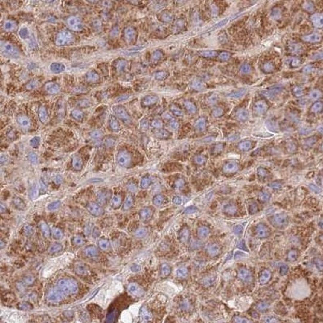 Immunohistochemistry-Paraffin: TID1 Antibody [NBP2-34066] - liver cancer